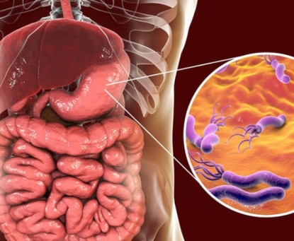 Nguyên nhân chính gây ra viêm dạ dày